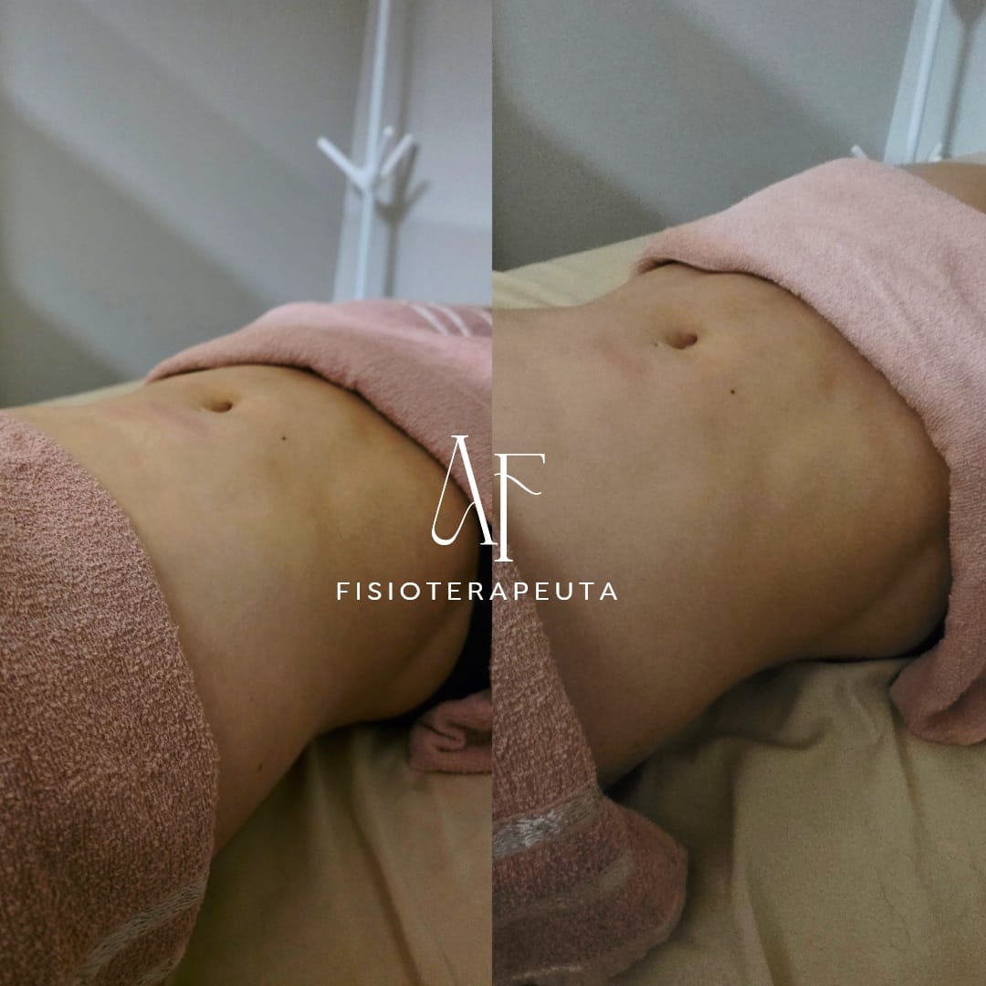 Pós-operatório abdominal — antes e depois