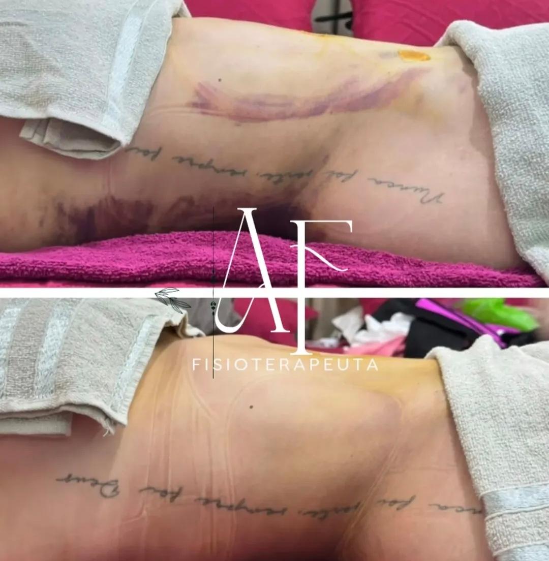 Tratamento de hematomas e fibroses
