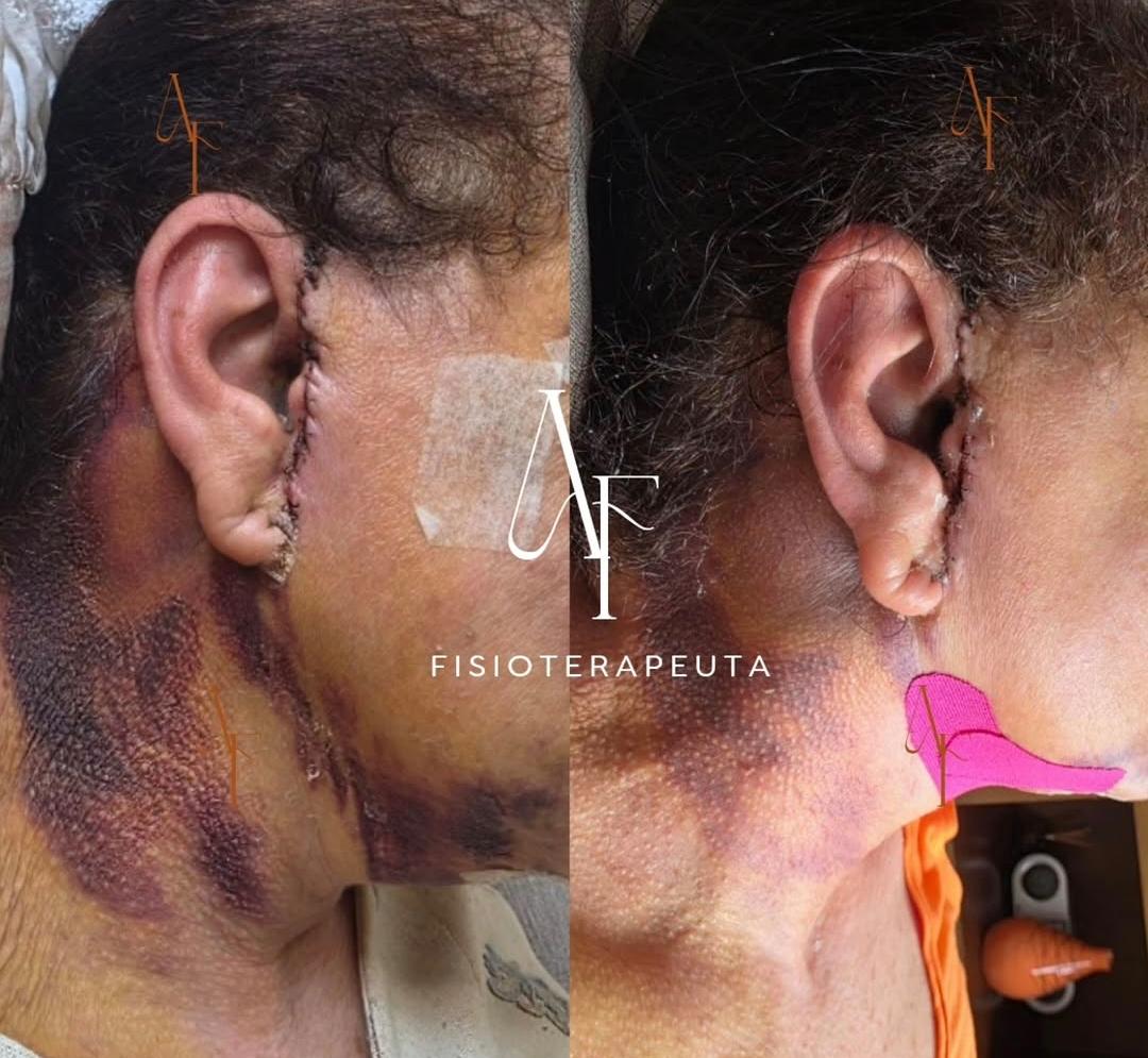 Drenagem facial pós-cirúrgica