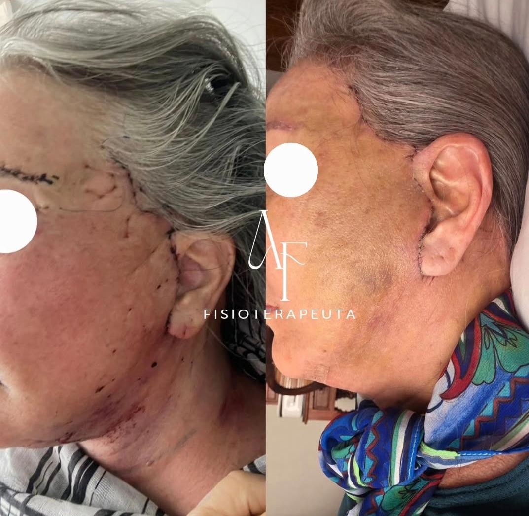 Cicatrização facial